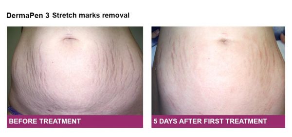 How to remove stretch marks? - DermaVille
